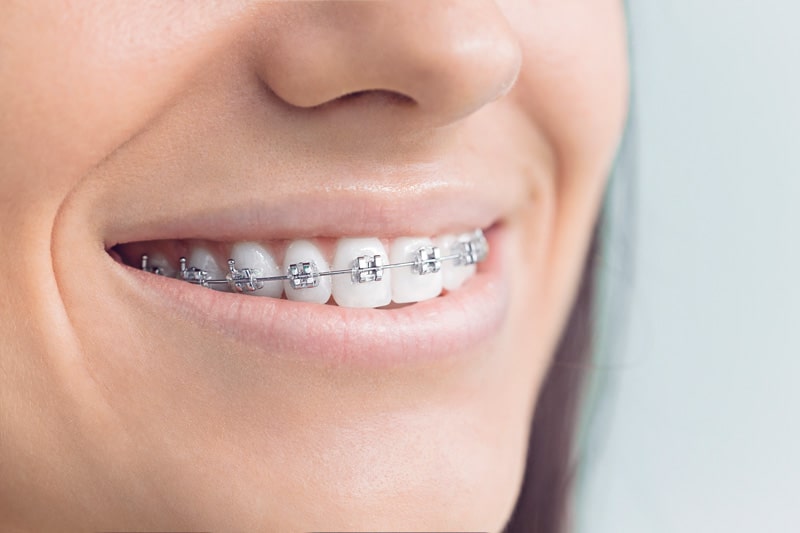 Metal Braces, Traditional Braces