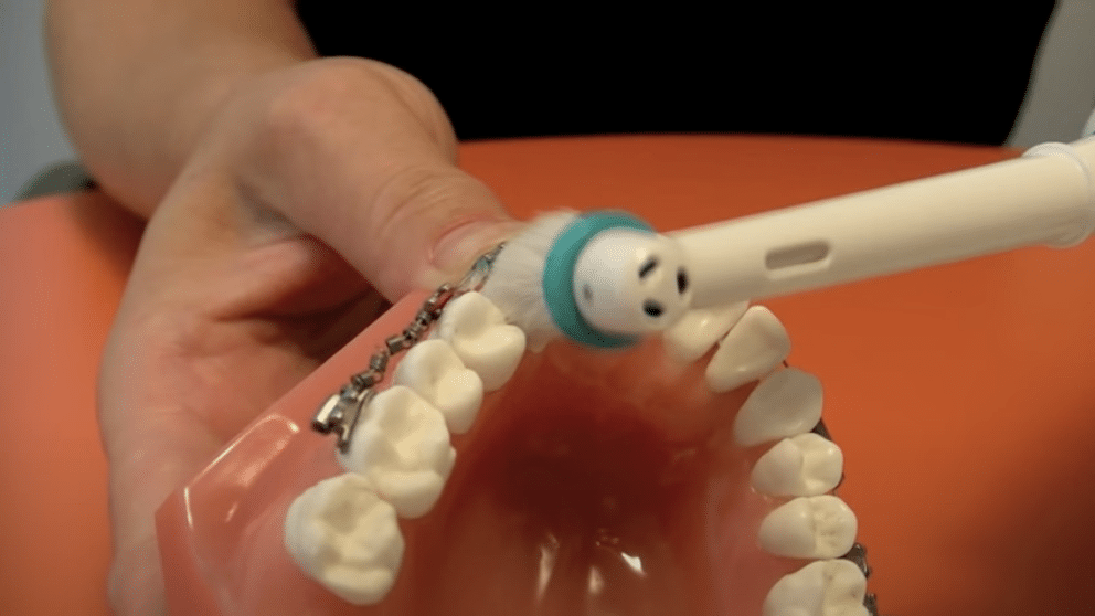 Proper brushing with braces
